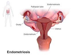 Cara Mengobati Endometriosis